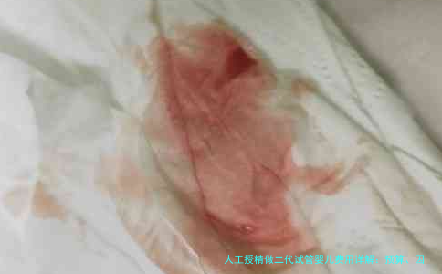 人工授精做二代试管婴儿费用详解：预算、因素与省钱攻略
