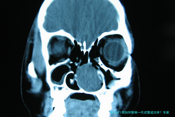 精子DFI高如何影响一代试管成功率？专家解析完整流程与提升策略