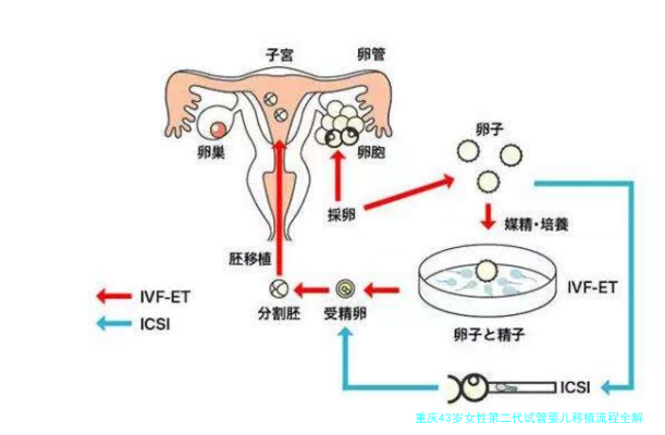 重庆43岁女性第二代试管婴儿移植流程全解析：从准备到成功的每一步