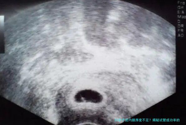 33岁子宫内膜厚度不足？揭秘试管成功率的关键因素与应对策略