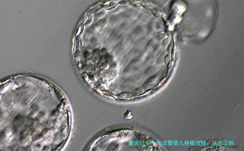重庆31岁一代试管婴儿移植流程：从忐忑到希望的全记录