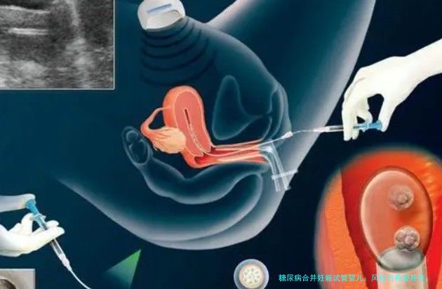 糖尿病合并妊娠试管婴儿:风险与希望并存,你需要知道这些