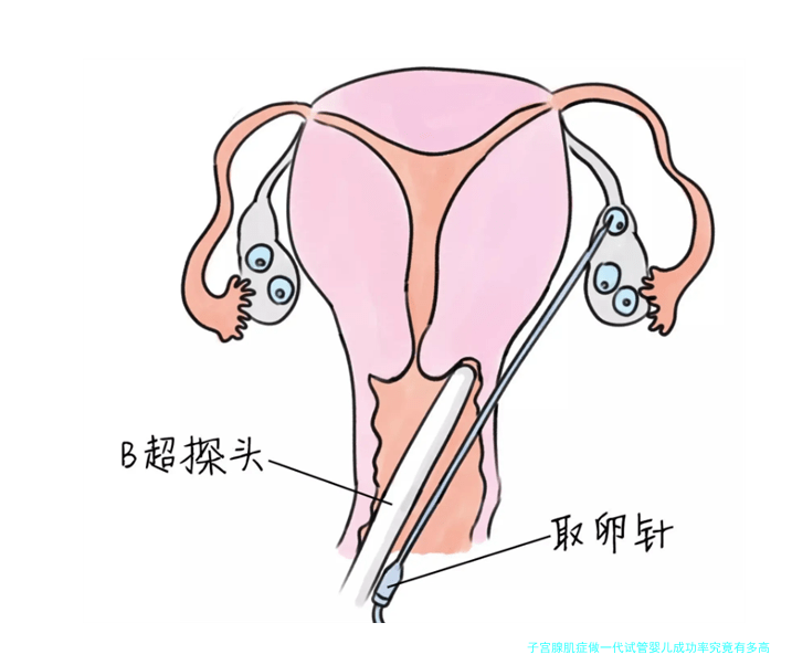 子宫腺肌症做一代试管婴儿成功率究竟有多高？医生说了大实话