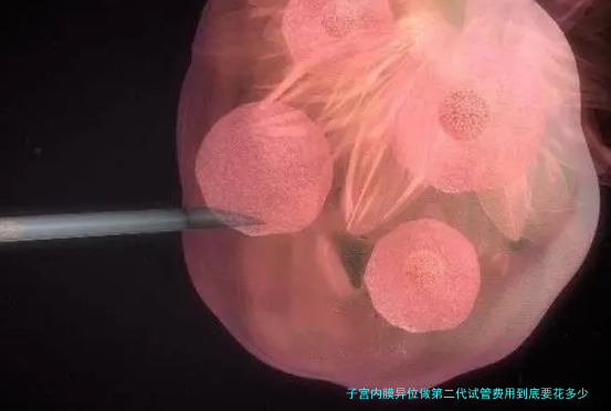 子宫内膜异位做第二代试管费用到底要花多少钱？一个过来人算的细账