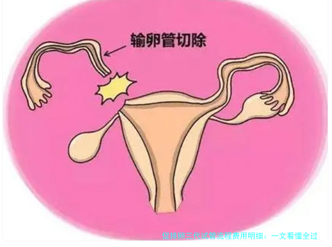 促排卵三代试管流程费用明细：一文看懂全过程与花费