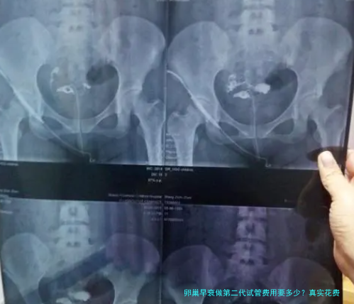 卵巢早衰做第二代试管费用要多少？真实花费大揭秘