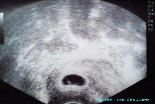 北京38岁做第一代试管，流程和成功率到底怎么样？