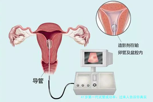41岁第一代试管成功率：过来人告诉你真实数据