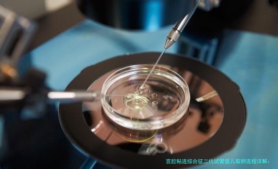 宫腔粘连综合征二代试管婴儿取卵流程详解：从准备到成功的关键步骤