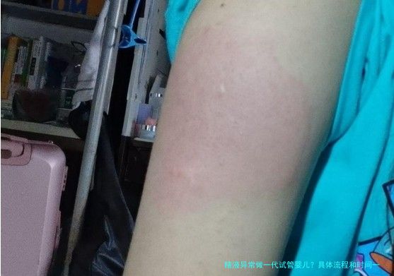 精液异常做一代试管婴儿？具体流程和时间一文说清