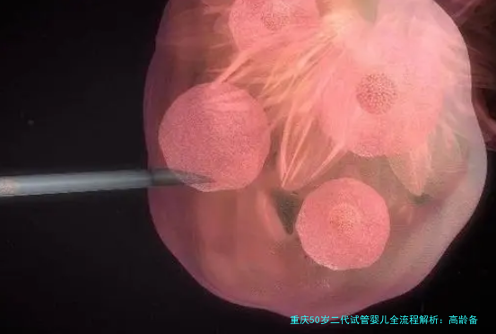 重庆50岁二代试管婴儿全流程解析：高龄备孕怎么做？