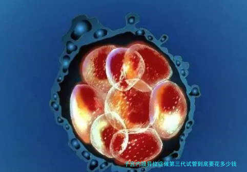 子宫内膜异位症做第三代试管到底要花多少钱？真实费用明细来了