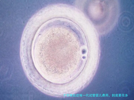 子宫腺肌症做一代试管婴儿费用，到底要花多少钱？