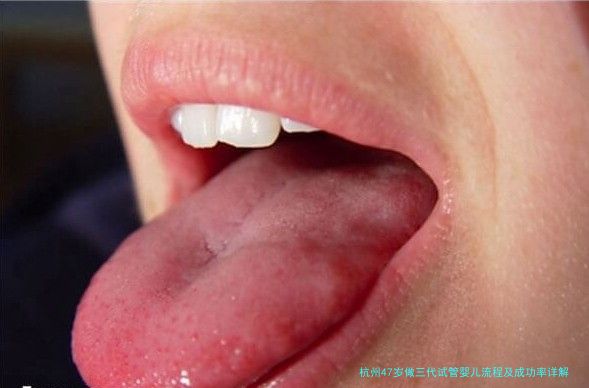 杭州47岁做三代试管婴儿流程及成功率详解