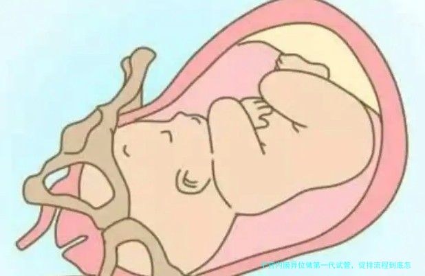子宫内膜异位做第一代试管，促排流程到底怎么走？过来人经验分享