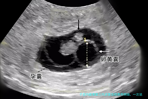 子宫内膜薄第三代试管流程费用明细，一次说清楚！