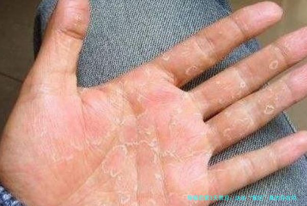 移植后第3天禁忌：这些“雷区”真的存在吗？