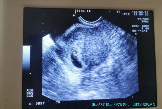 重庆49岁做三代试管婴儿，促排流程到底怎么样？一篇说清楚