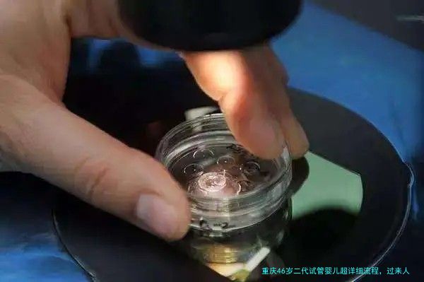 重庆46岁二代试管婴儿超详细流程，过来人告诉你每一步怎么走