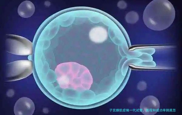 子宫腺肌症做一代试管，流程和成功率到底怎么样？
