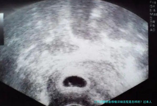 三代试管胚胎移植详细流程是怎样的？过来人分享真实步骤与注意事项