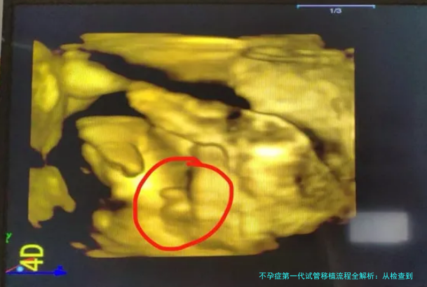 不孕症第一代试管移植流程全解析：从检查到移植的详细步骤