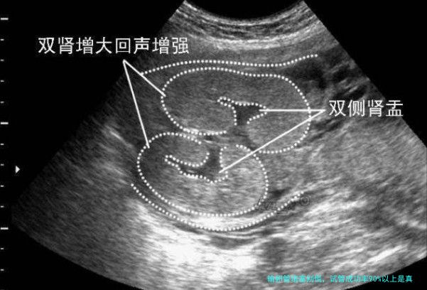 输卵管堵塞别慌，试管成功率90%以上是真的吗？