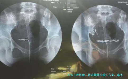 32岁在武汉做二代试管婴儿超长方案，真实流程分享