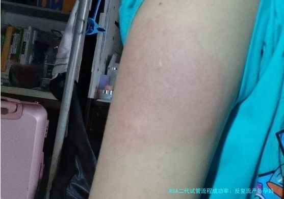RSA二代试管流程成功率：反复流产备孕妈妈的“避坑”指南