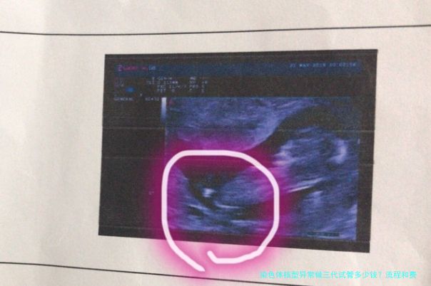 染色体核型异常做三代试管多少钱？流程和费用明细全拆解