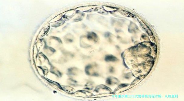 今年重庆第三代试管移植流程详解：从检查到验孕，每一步都给你说明白