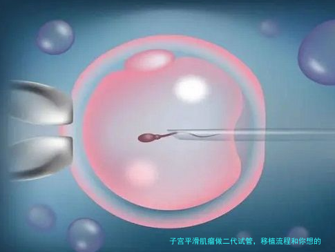 子宫平滑肌瘤做二代试管，移植流程和你想的不一样