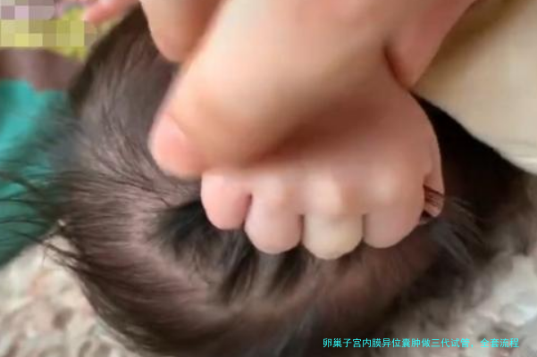 卵巢子宫内膜异位囊肿做三代试管，全套流程详细解读（附成功经验）