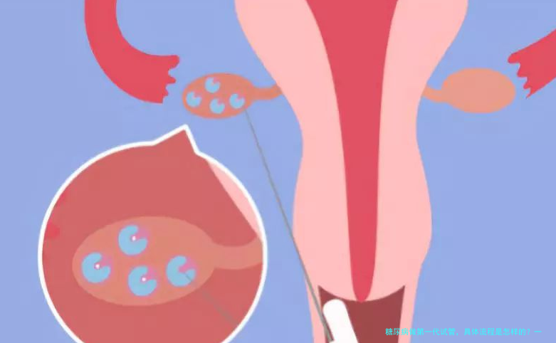 糖尿病做第一代试管,具体流程是怎样的?一文讲透