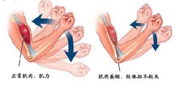 肌肉萎缩症