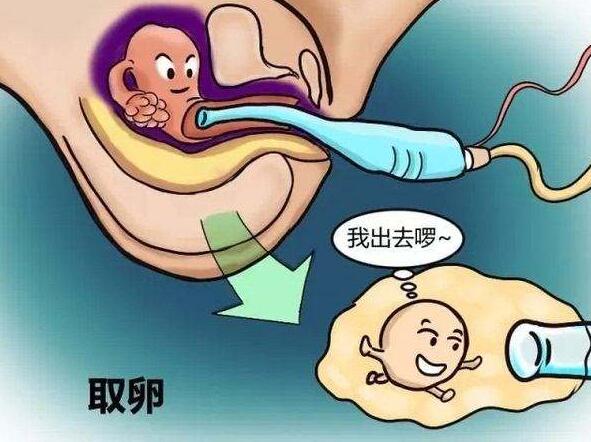 试管婴儿取卵