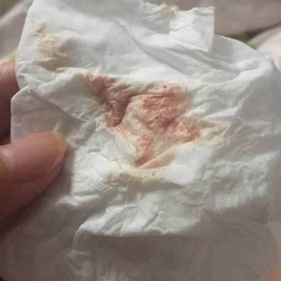 试管婴儿移植后出血