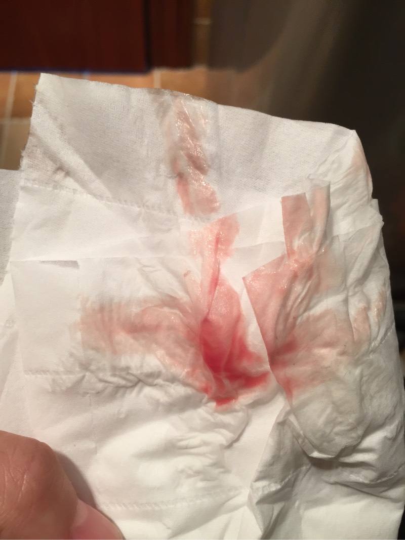 试管婴儿移植后出血