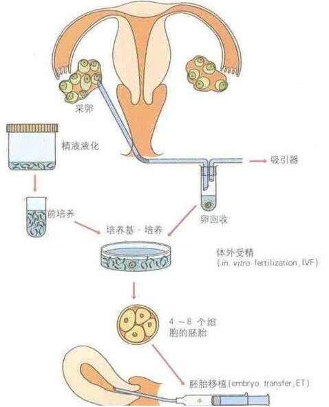 试管婴儿流程图