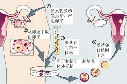 第一代试管婴儿