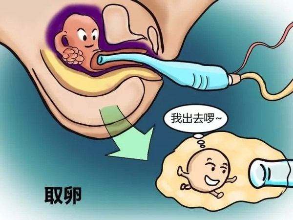 试管婴儿取卵