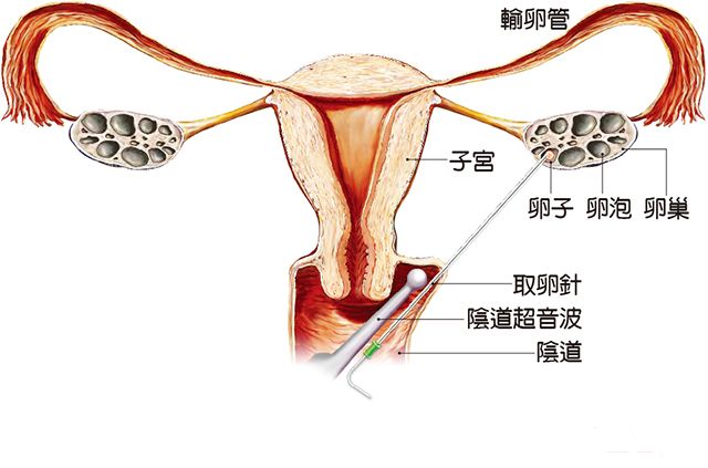 试管婴儿取卵