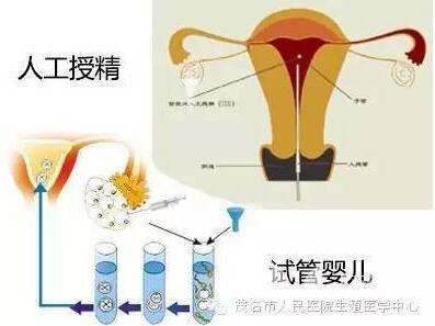 人工授精跟试管婴儿的区别