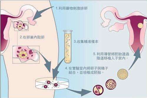 试管婴儿全流程