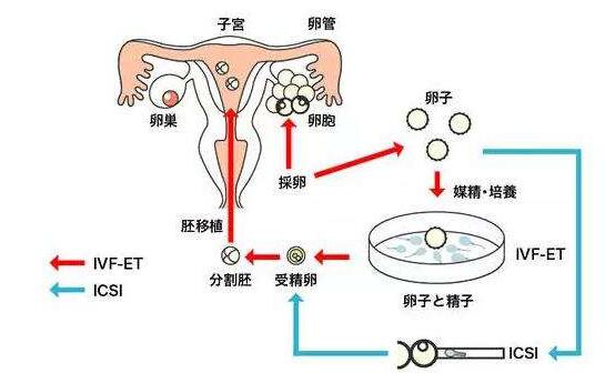 体外受精