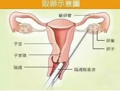 取卵针取卵示意图