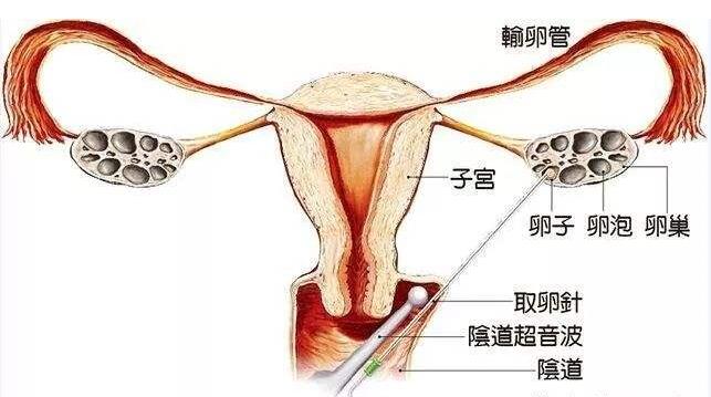 取卵针取卵示意图